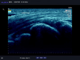 Ultrazvok zapestja - normalen izvid zapestja, v sredini zapestna koščica os lunatum